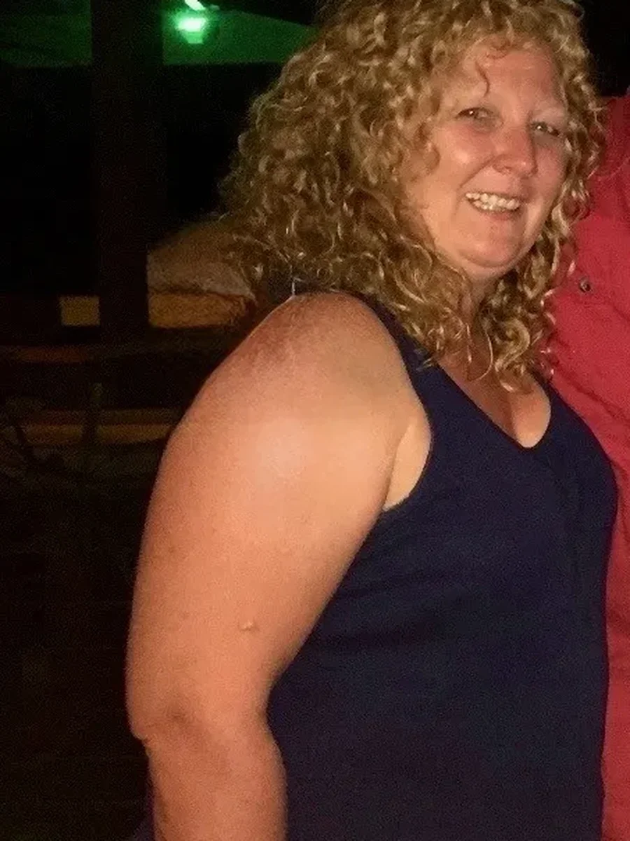 Dr. Baptista bariatric patient 90 before and after weight loss - Before