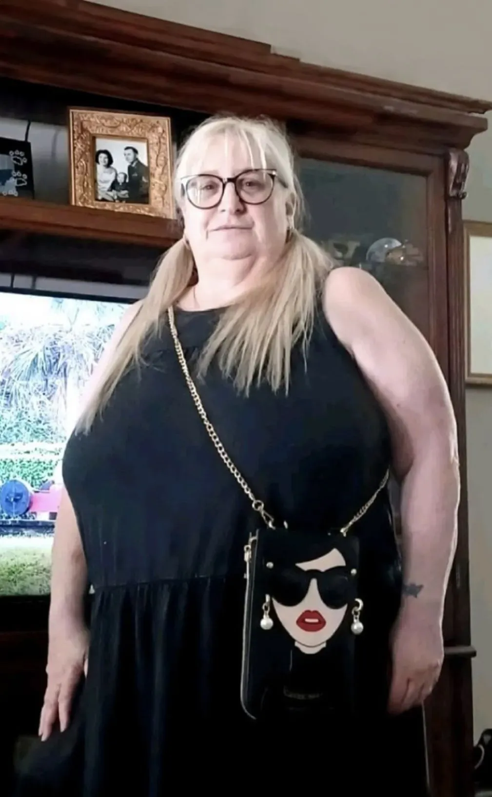 Before weight loss surgery