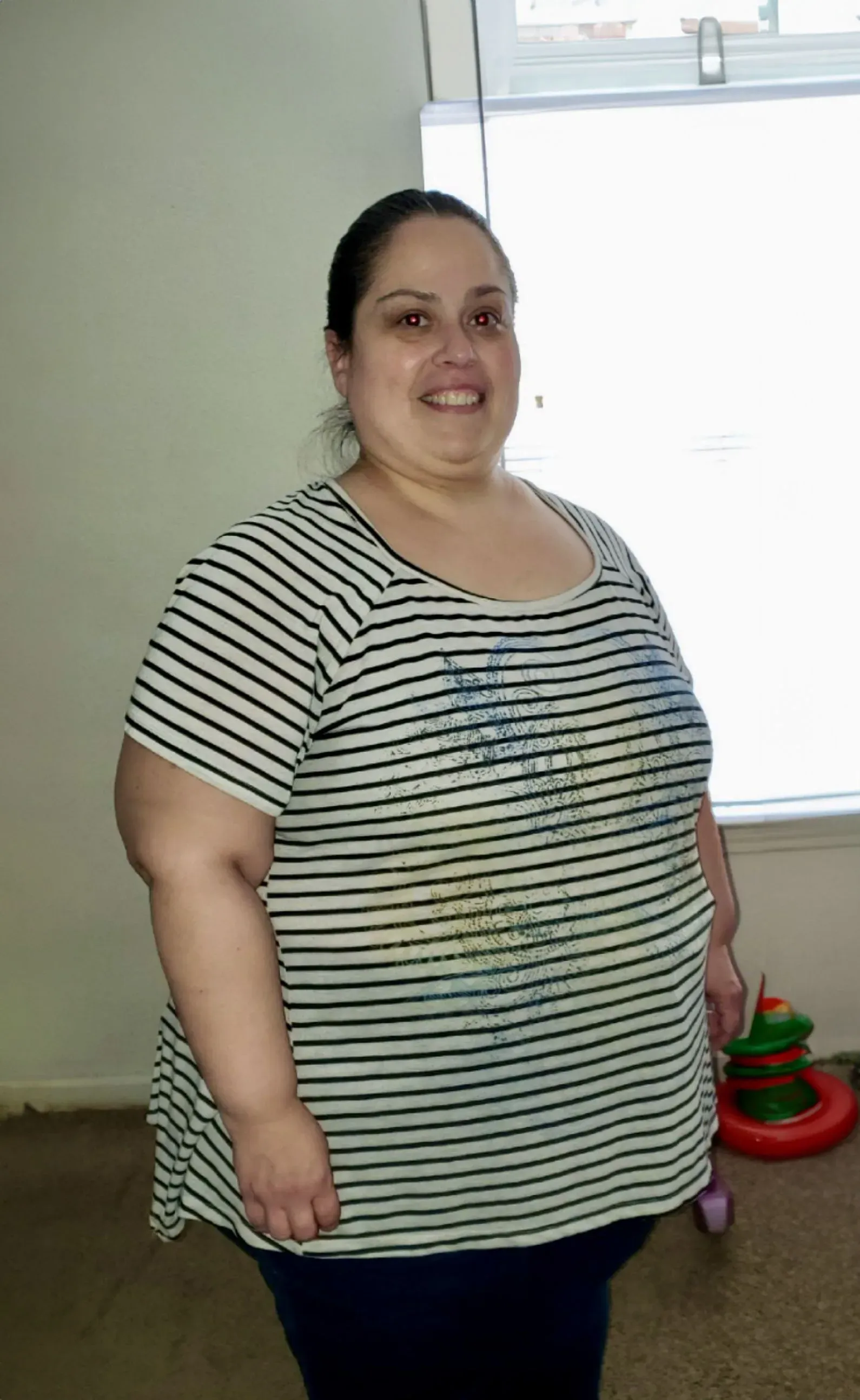 Before weight loss surgery