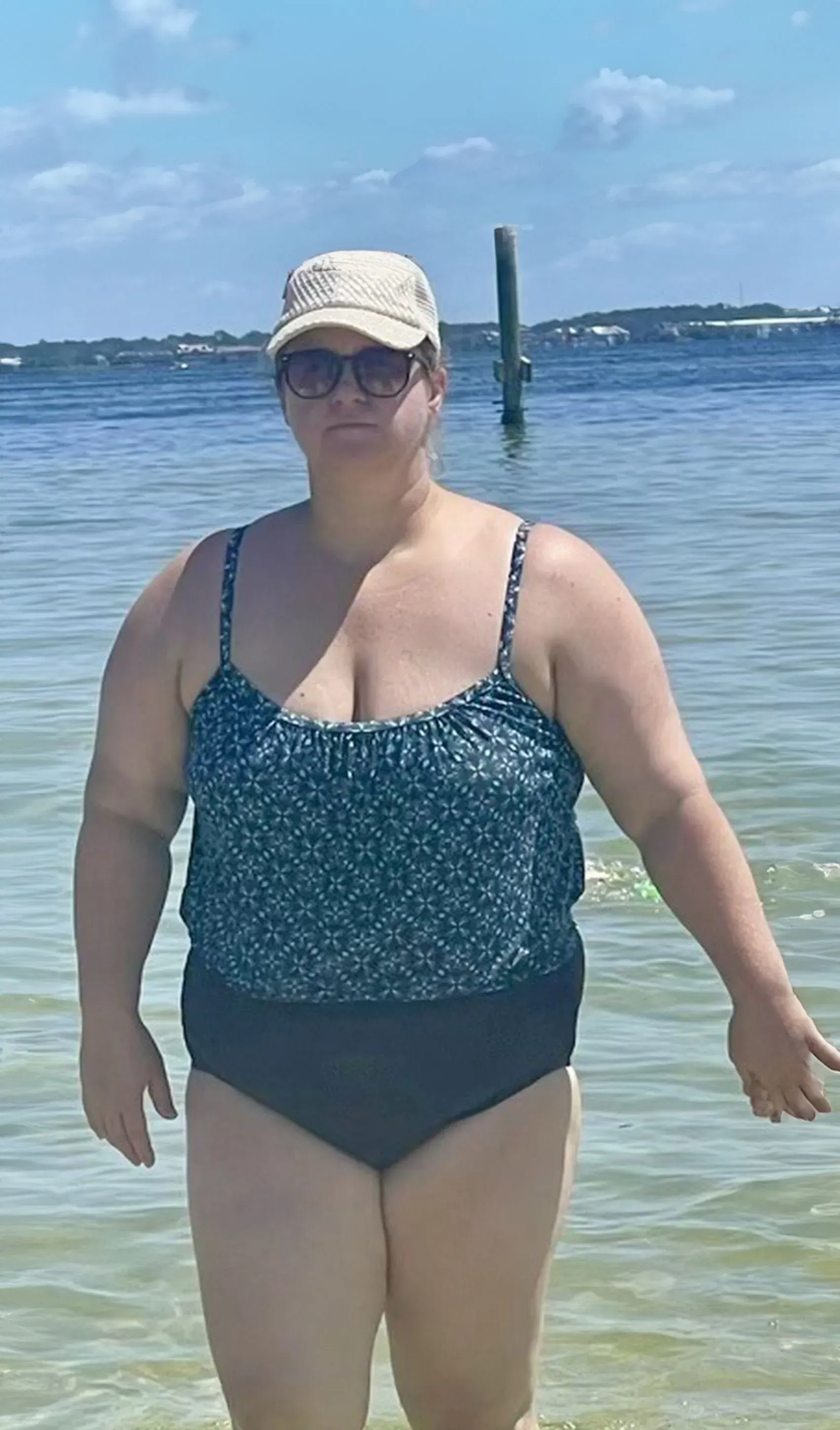 Before weight loss surgery