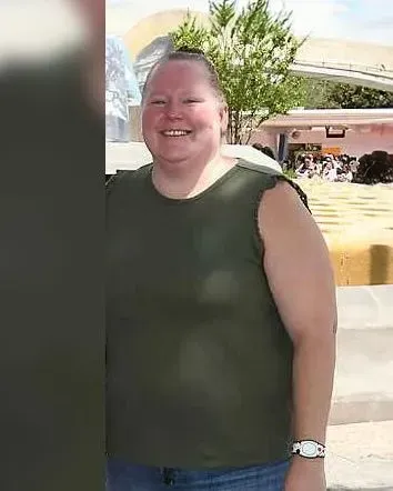 Before weight loss surgery