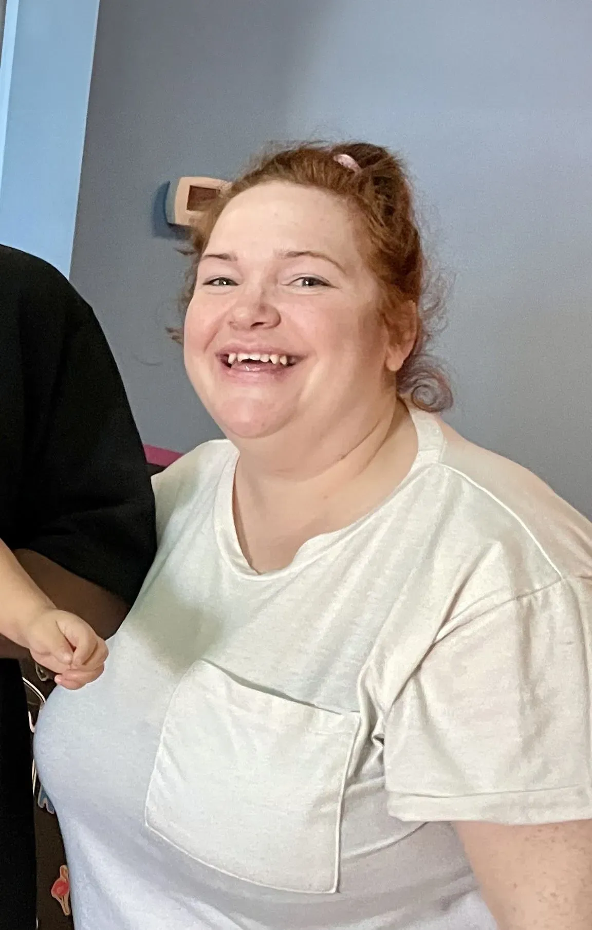 Before weight loss surgery