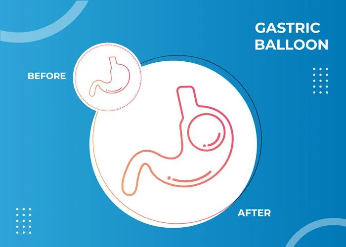 Weight Loss with the Gastric Balloon