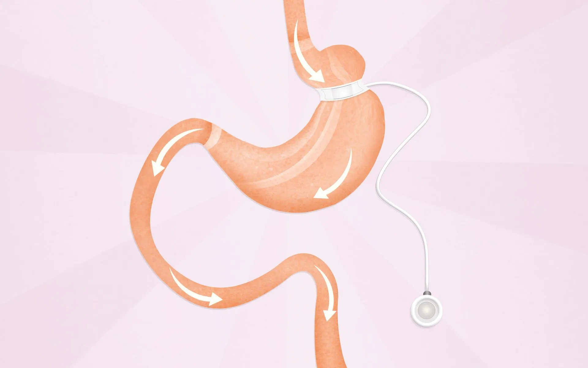 Lap Band Surgery Diagram