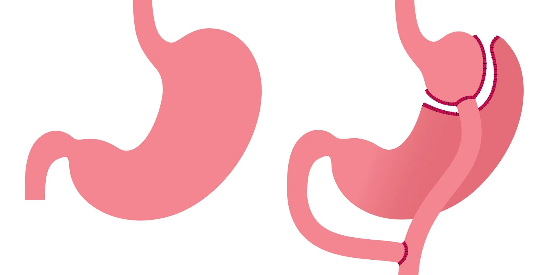 Gastric Bypass Surgery Diagram