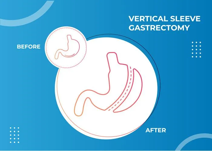 Sleeve Gastrectomy